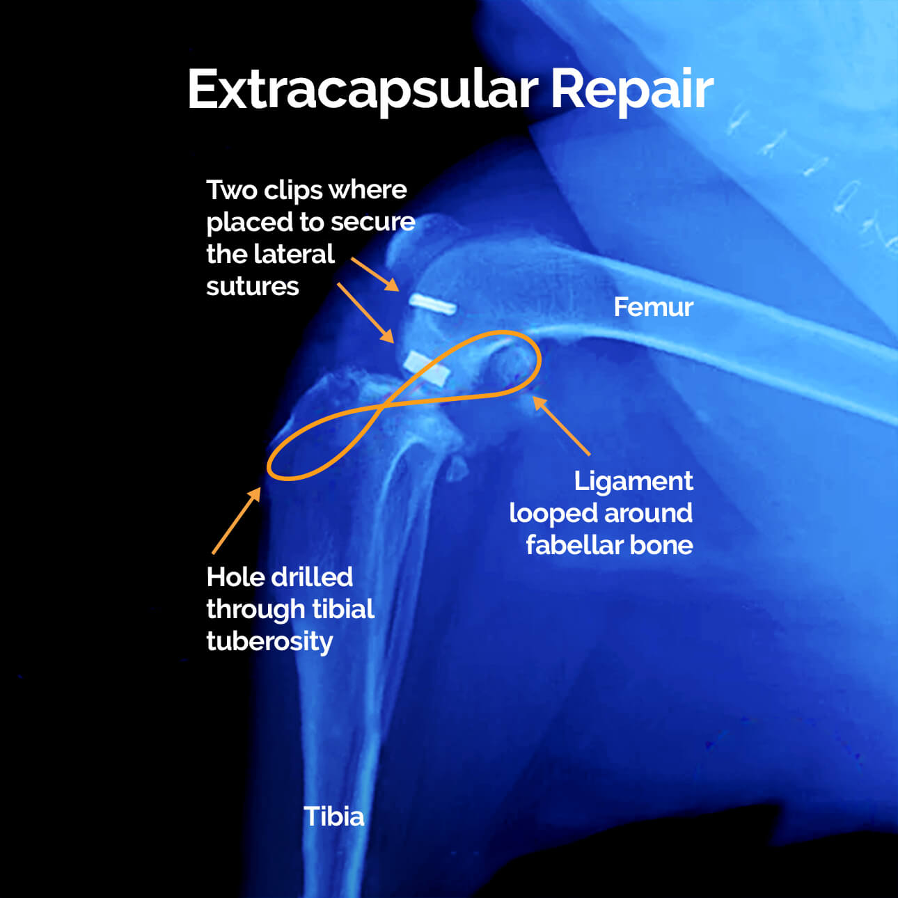 ACL Tear Recovery: Surgery & Treatment Options